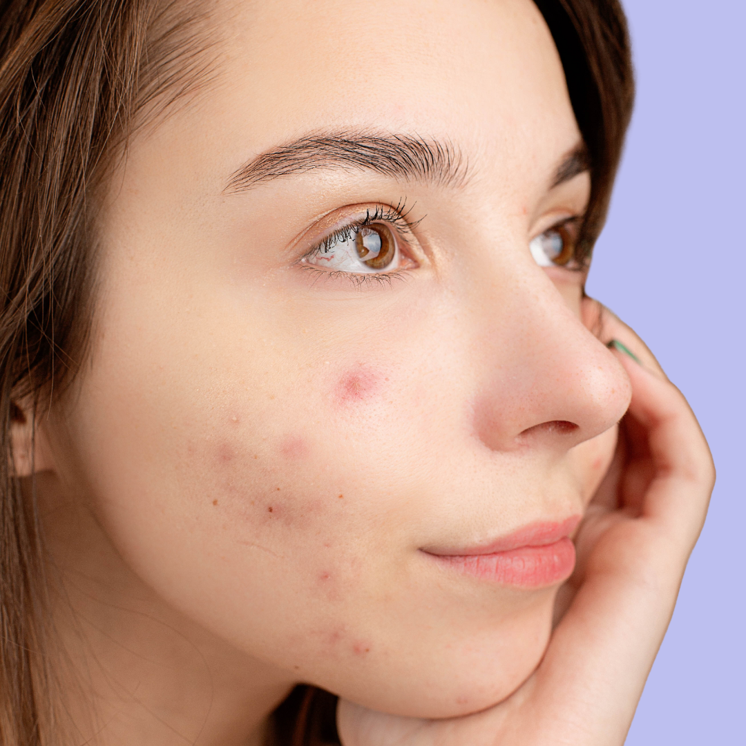 Image of person with blemishes
