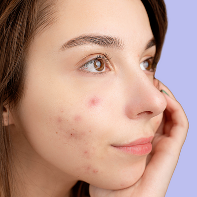 Clear Skin Guide: Solutions for Acne, Breakouts and Blackheads